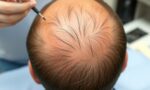 Пересадка волос на голову: как вернуть себе уверенность и молодость