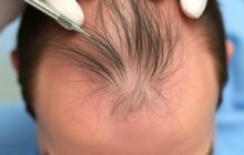 Волосы на шрамах и ожогах: как добиться естественного результата и чего ожидать