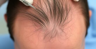 Волосы на шрамах и ожогах: как добиться естественного результата и чего ожидать